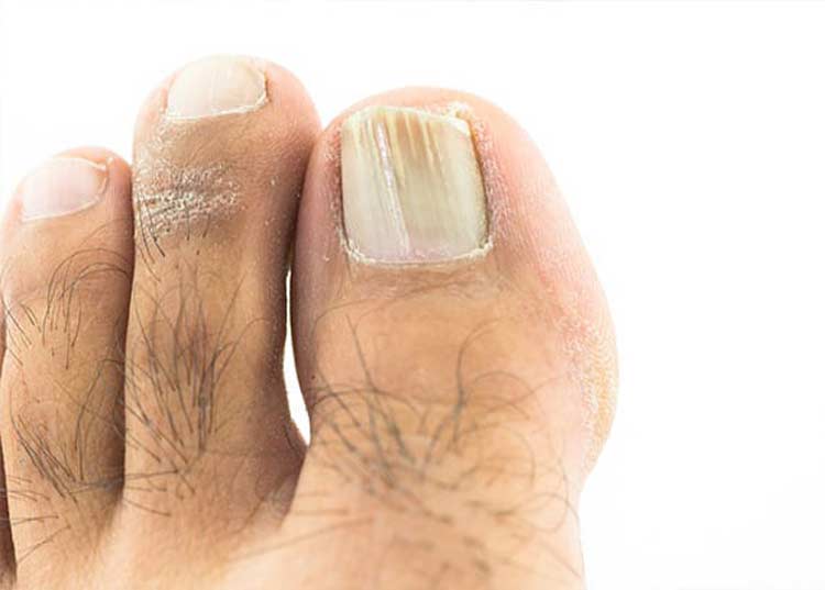 Toenail problem with large toe.