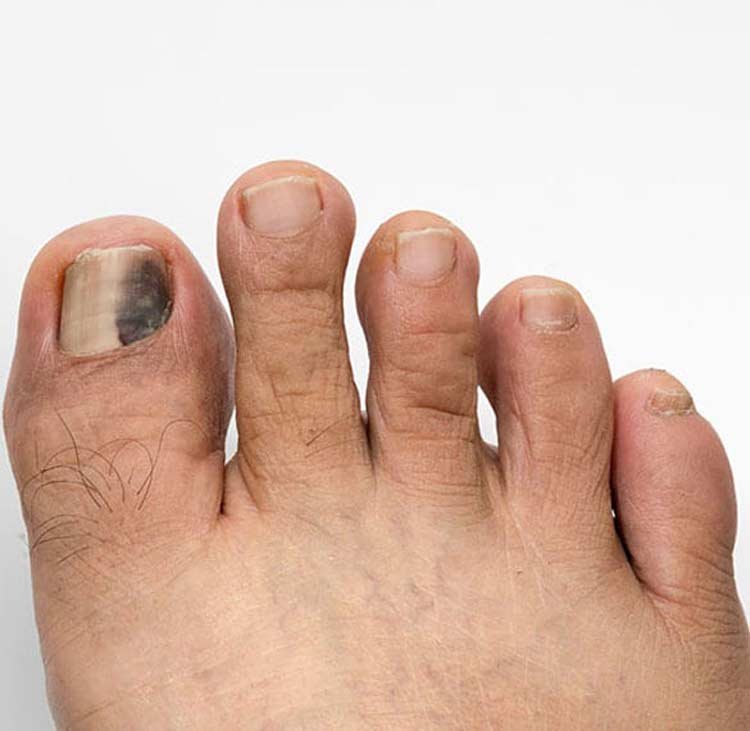 Foot with discoloration to the big toe because of toenail problems.