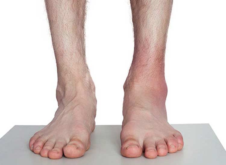 Pair of feet with sprain on one foot.