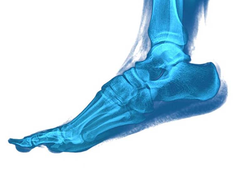 Animated x-ray of foot in need of surgical flat foot correction.