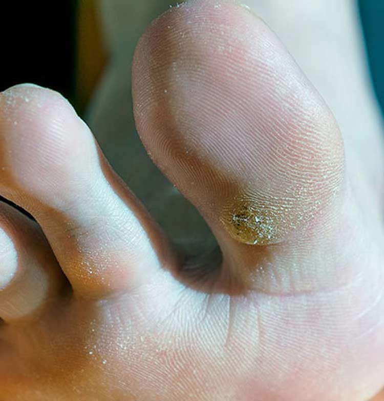 Toes with plantar warts.