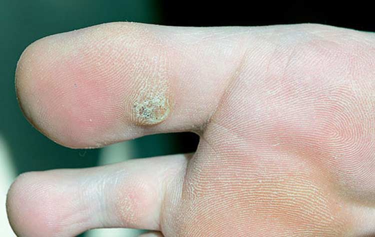 Big toe suffering with plantar wart.