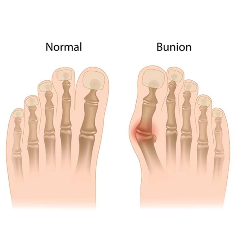 Best Bunion Surgeon in Los Angeles Burbank Podiatrist Los Angeles