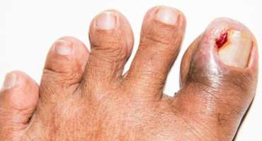 Click here to learn more Best Hammertoe Clinic in Los Angeles