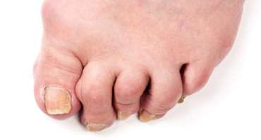 Click here to learn more Best Hammertoe Surgeon in Los Angeles