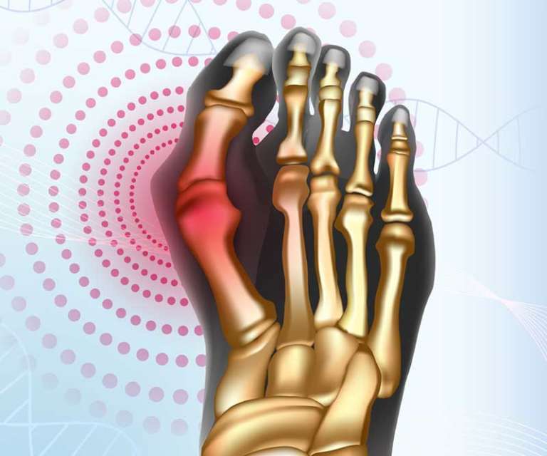 Bunions Burbank Podiatrist Los Angeles Foot & Ankle Center